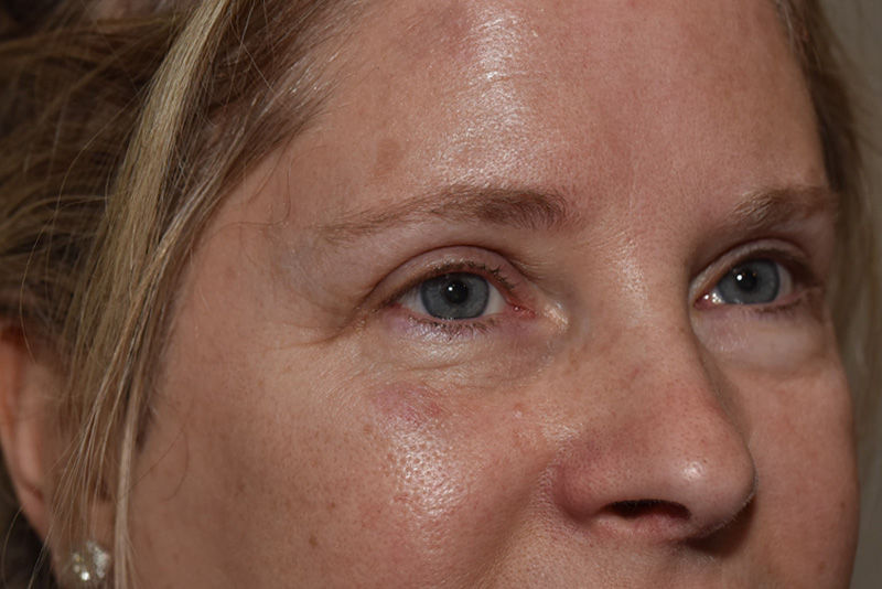 Endoscopic Brow Lift Before & After Image