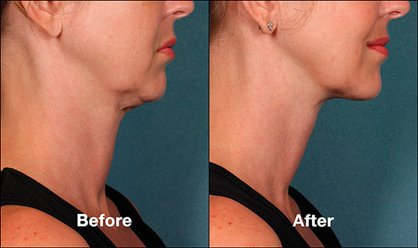 Kybella Before and After photos Philadelphia