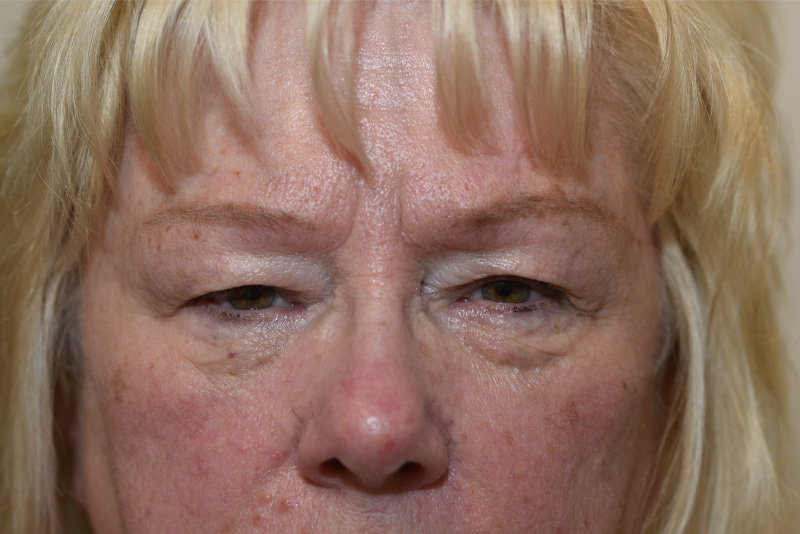 Endoscopic Brow Lift Before & After Image